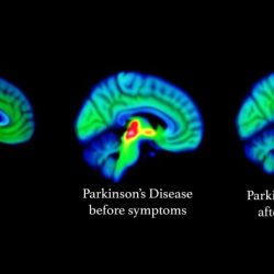 Hesi case study parkinson's disease